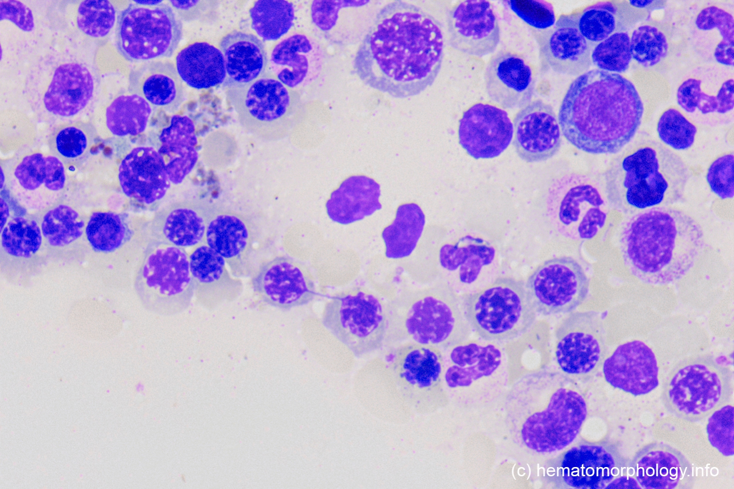 Congenital dyserythropoietic anemia (CDA) Hematomorphology, a
