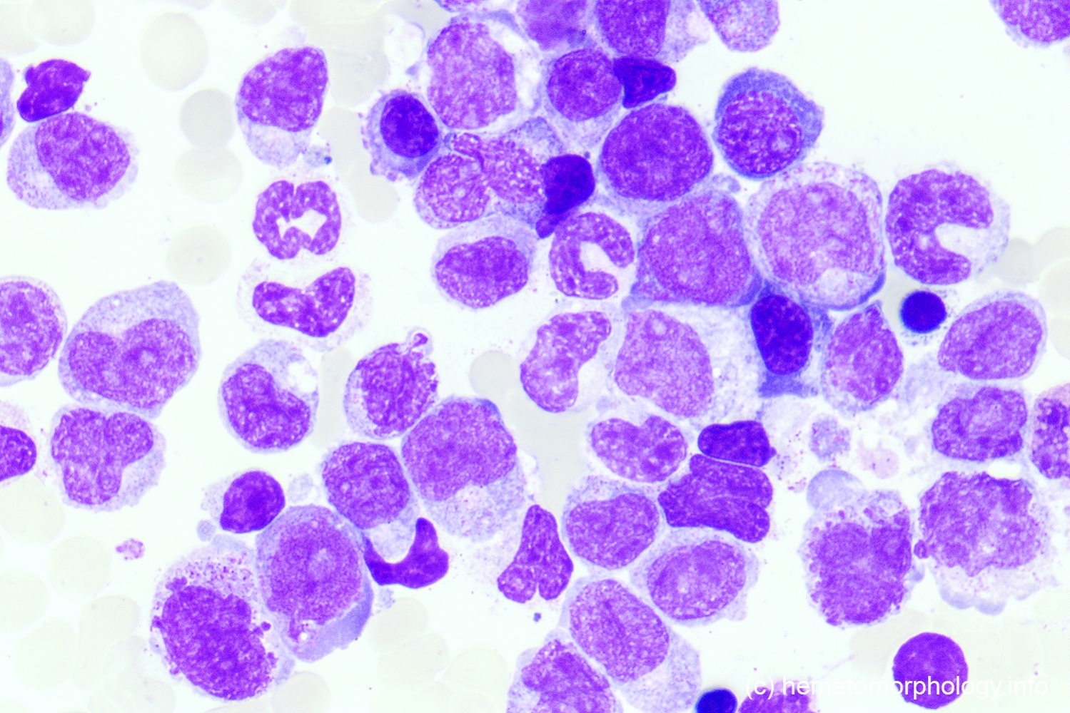 Chronic Myelomonocytic Leukemia (CMML) Hematomorphology