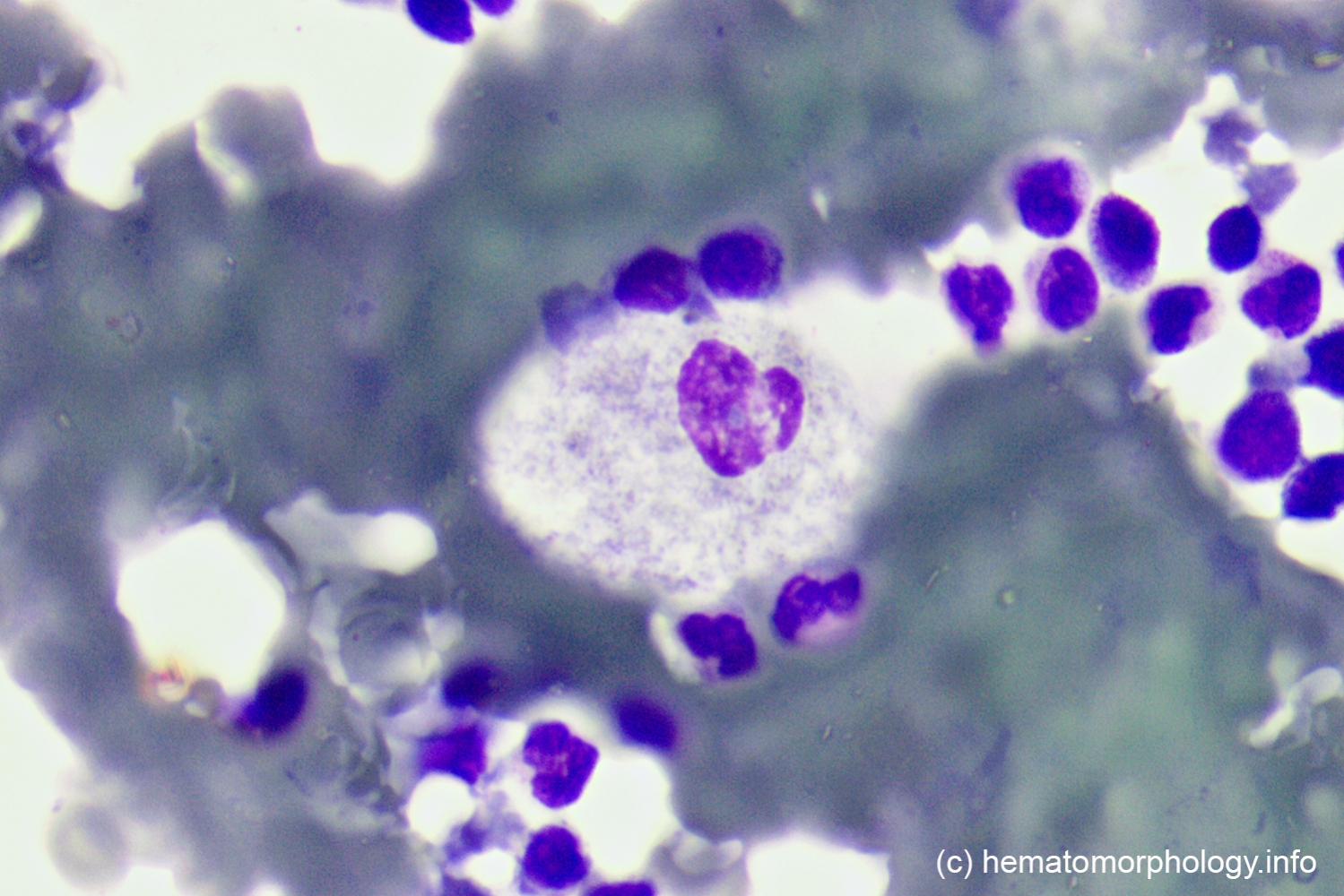 Gaucher's disease Hematomorphology, a databank / imagebank for