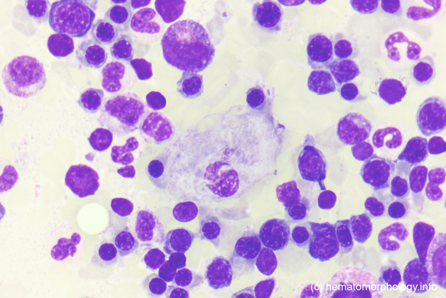 Gaucher's disease Hematomorphology, a databank / imagebank for