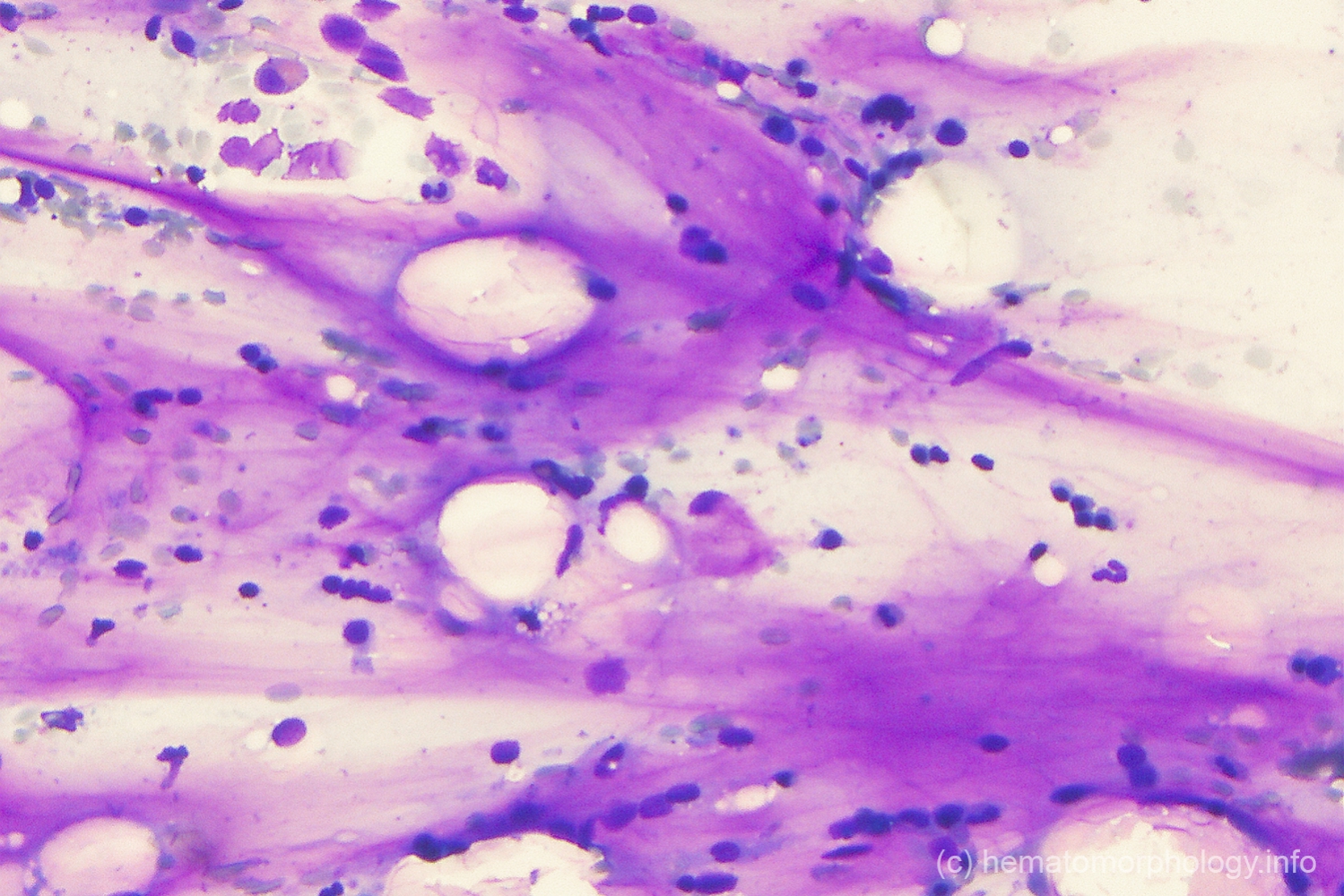 Gelatinous transformation Hematomorphology, a databank / imagebank