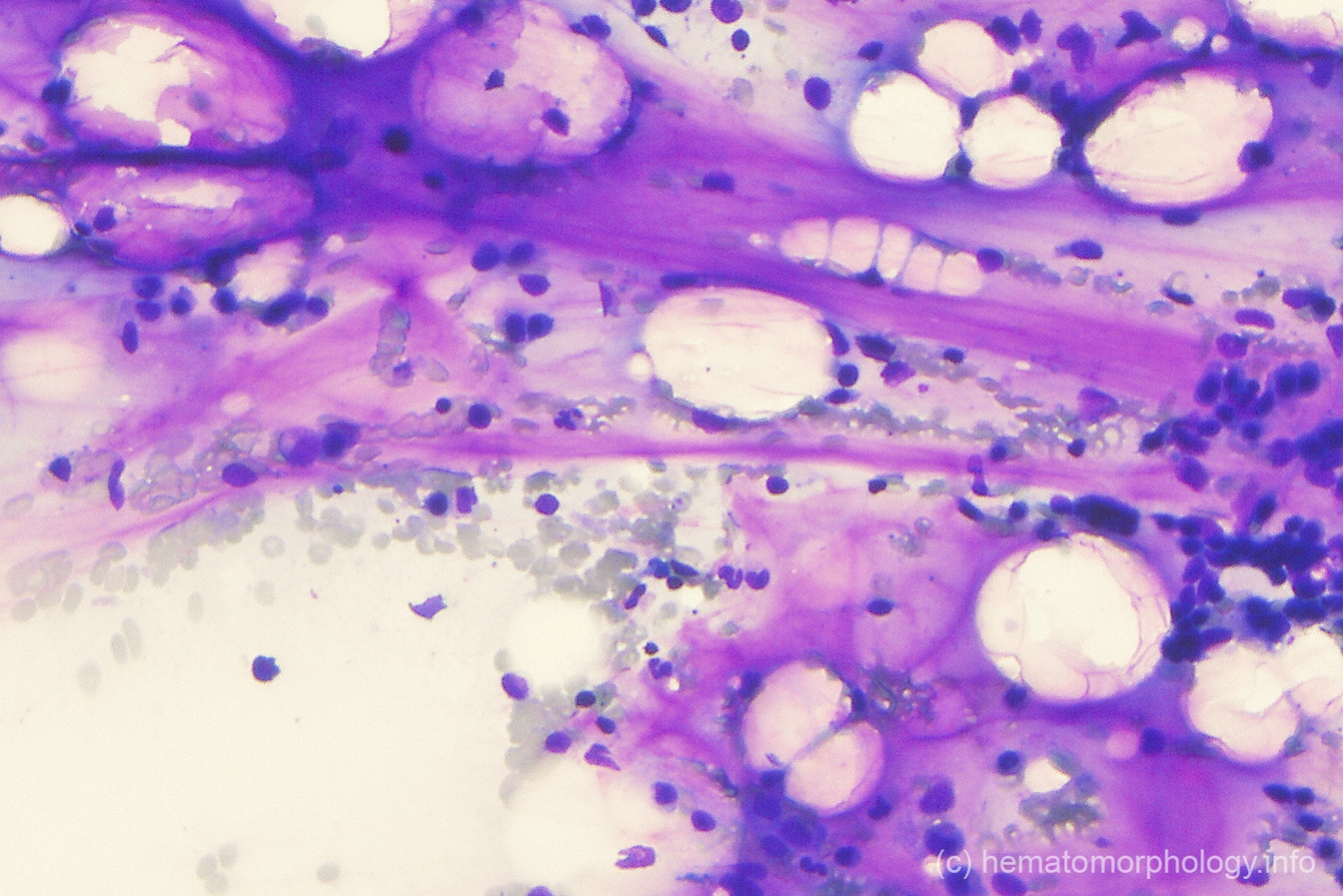 Gelatinous transformation Hematomorphology, a databank / imagebank