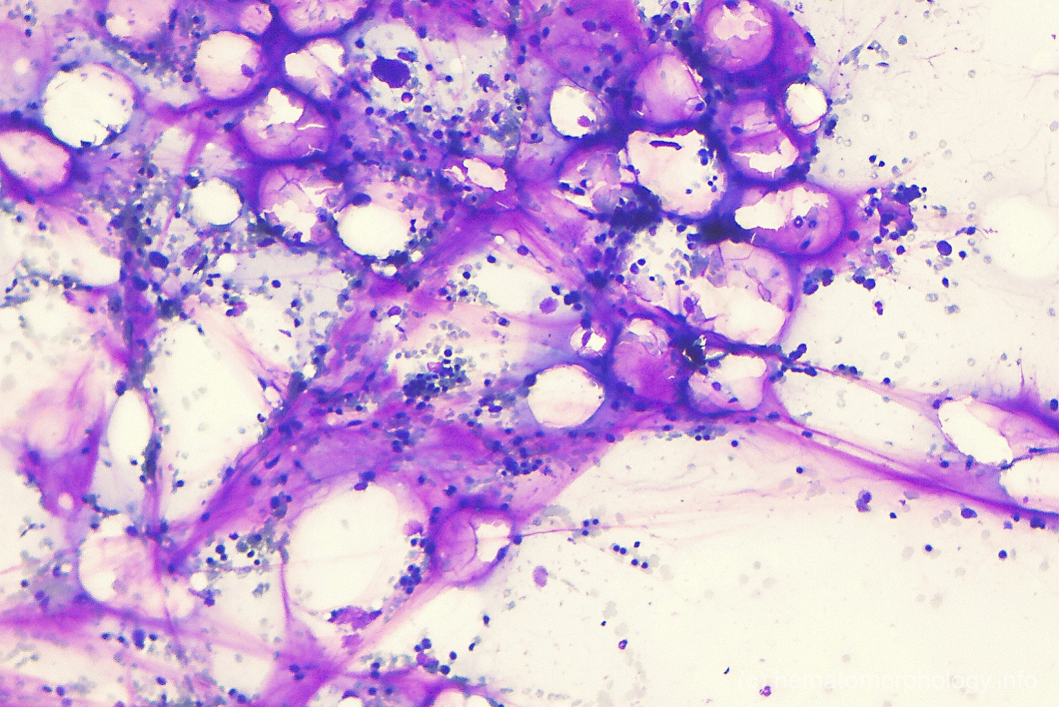 Gelatinous transformation Hematomorphology, a databank / imagebank