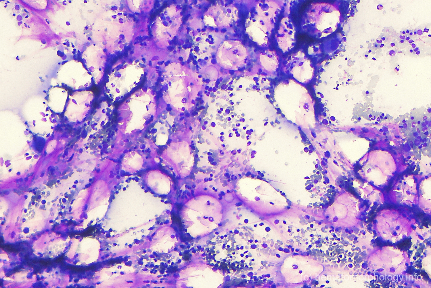 Gelatinous transformation Hematomorphology, a databank / imagebank