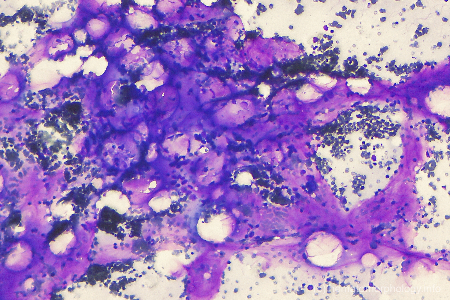 Gelatinous transformation Hematomorphology, a databank / imagebank
