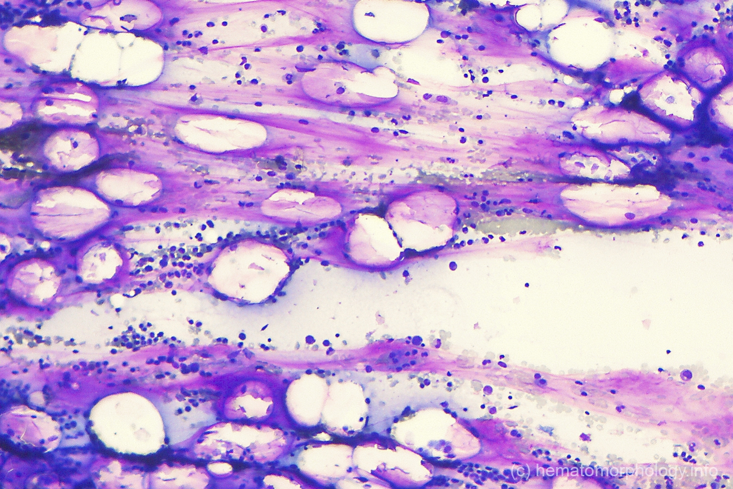 Gelatinous transformation Hematomorphology, a databank / imagebank
