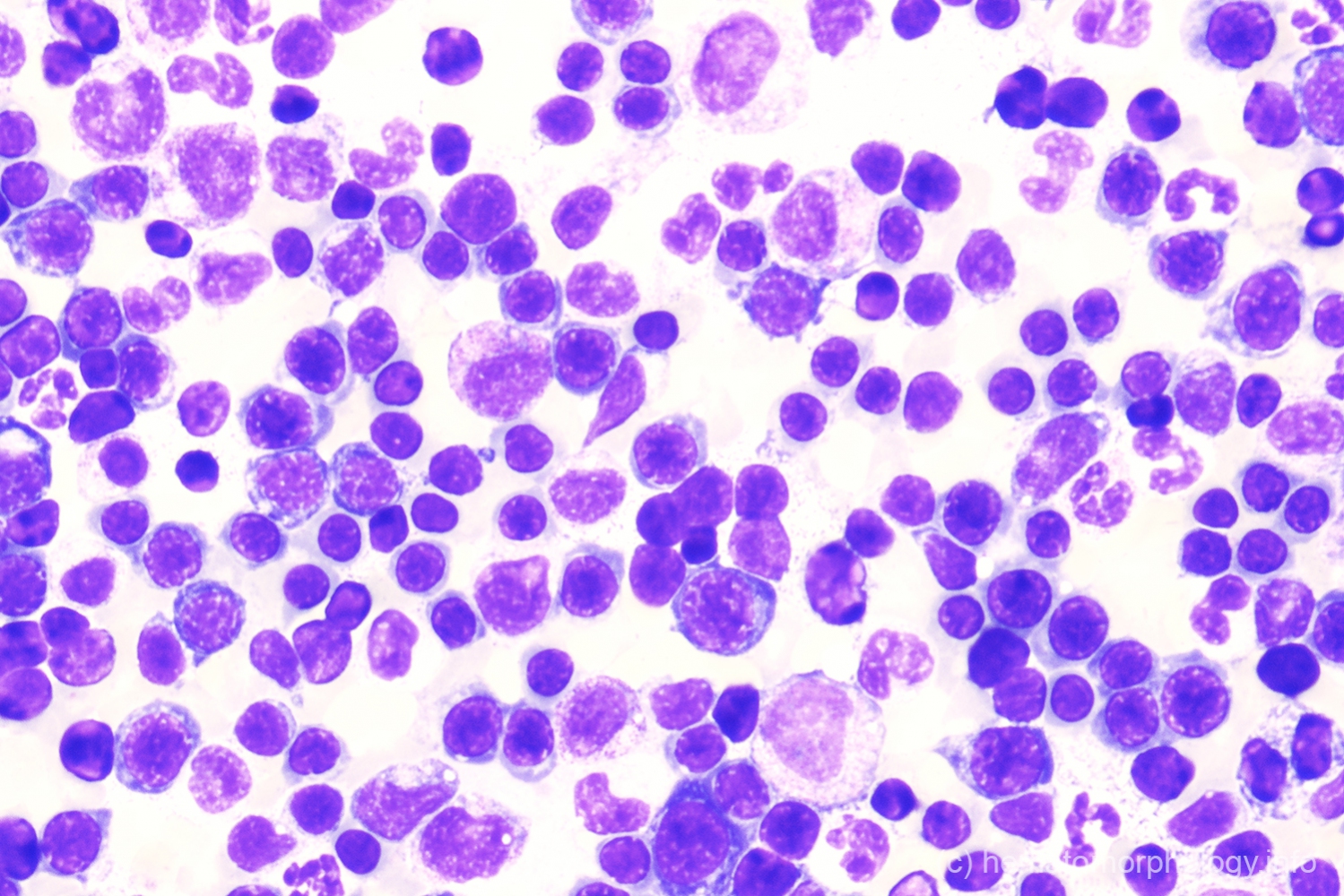 Hemolytic anemia Hematomorphology, a databank / imagebank for