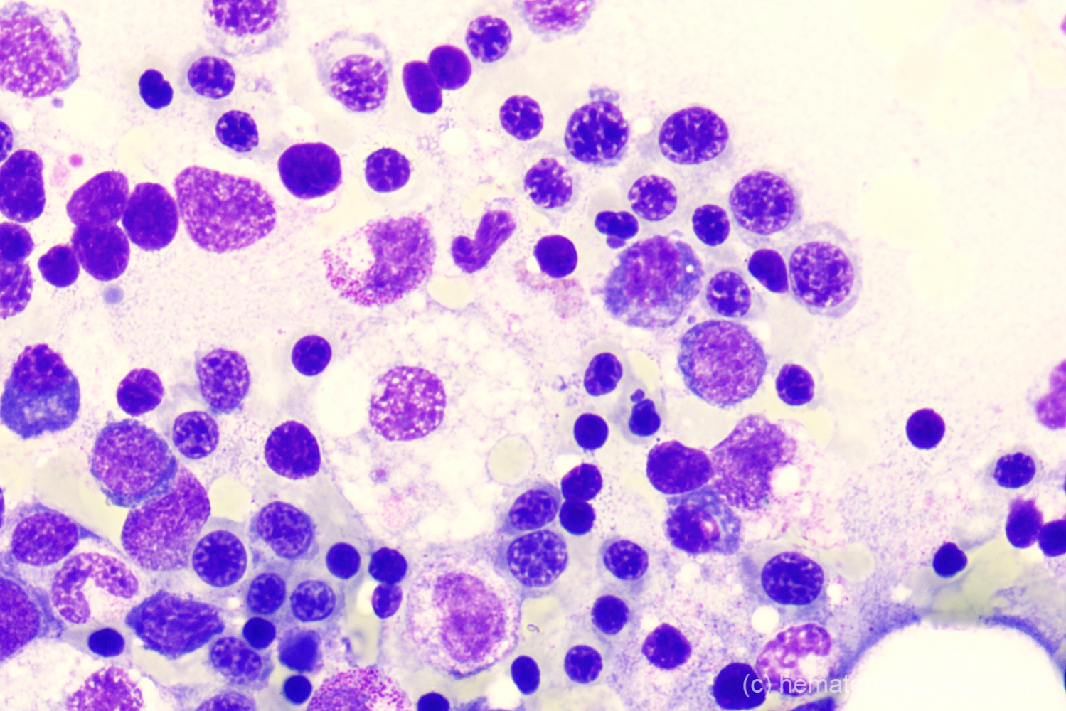 Hemolytic anemia Hematomorphology, a databank / imagebank for