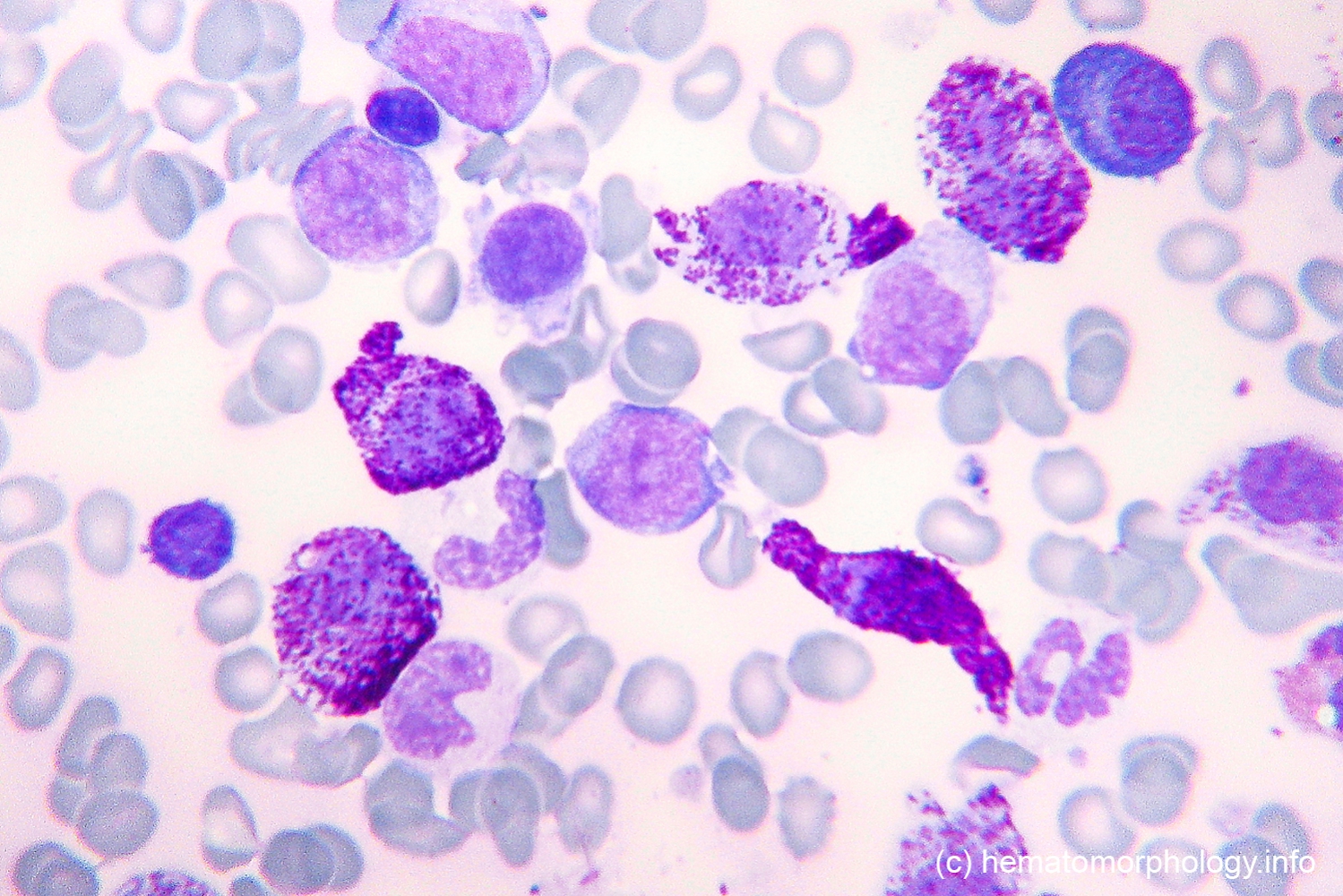 Acute Basophilic Leukemia (ABL) - Hematomorphology, a databank ...