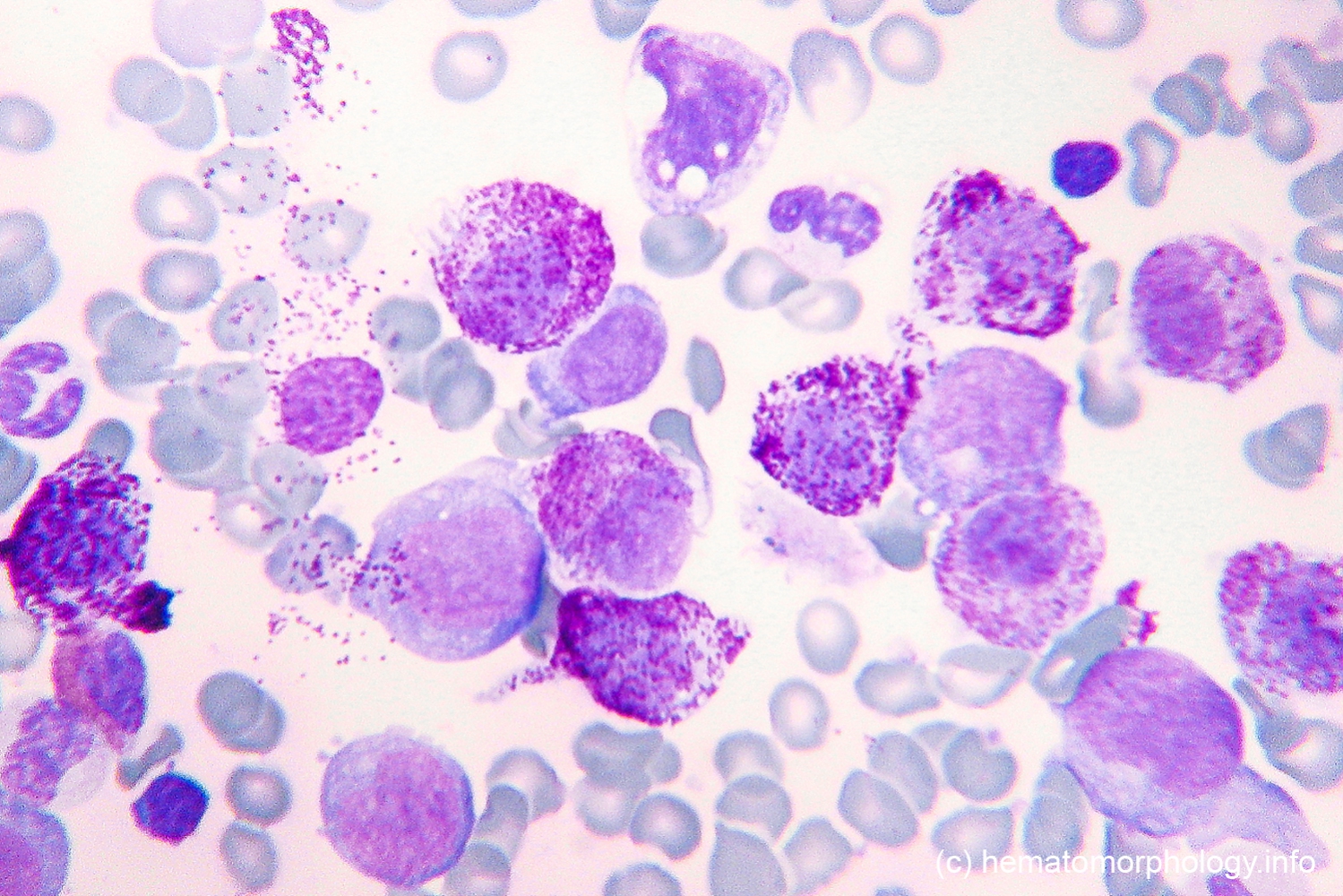 Acute Basophilic Leukemia (ABL) - Hematomorphology, a databank ...