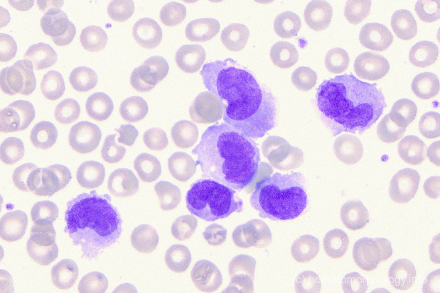 Monocytes - Hematomorphology, a databank / imagebank for hematology