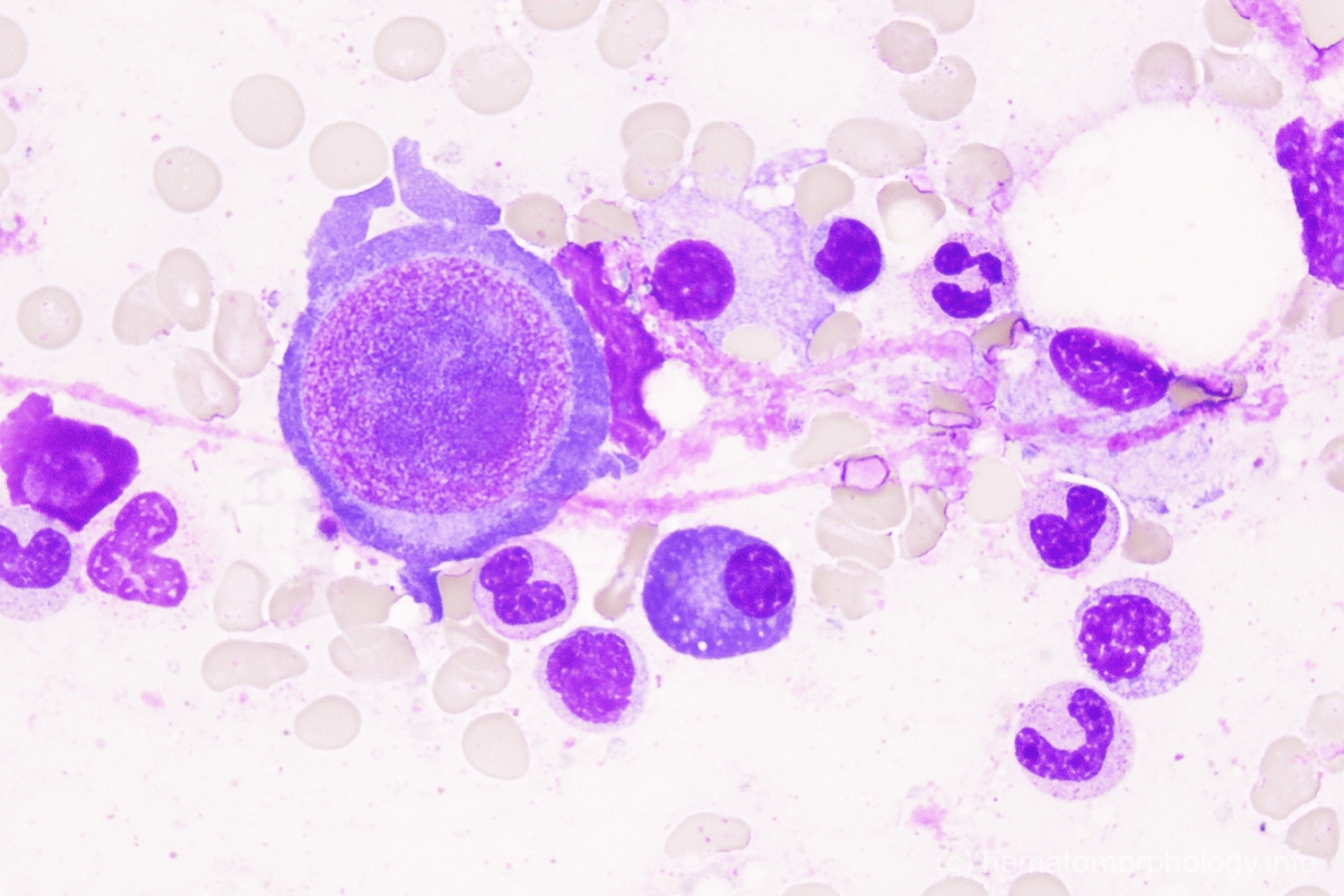 Parvo infection - Hematomorphology, a databank / imagebank for ...