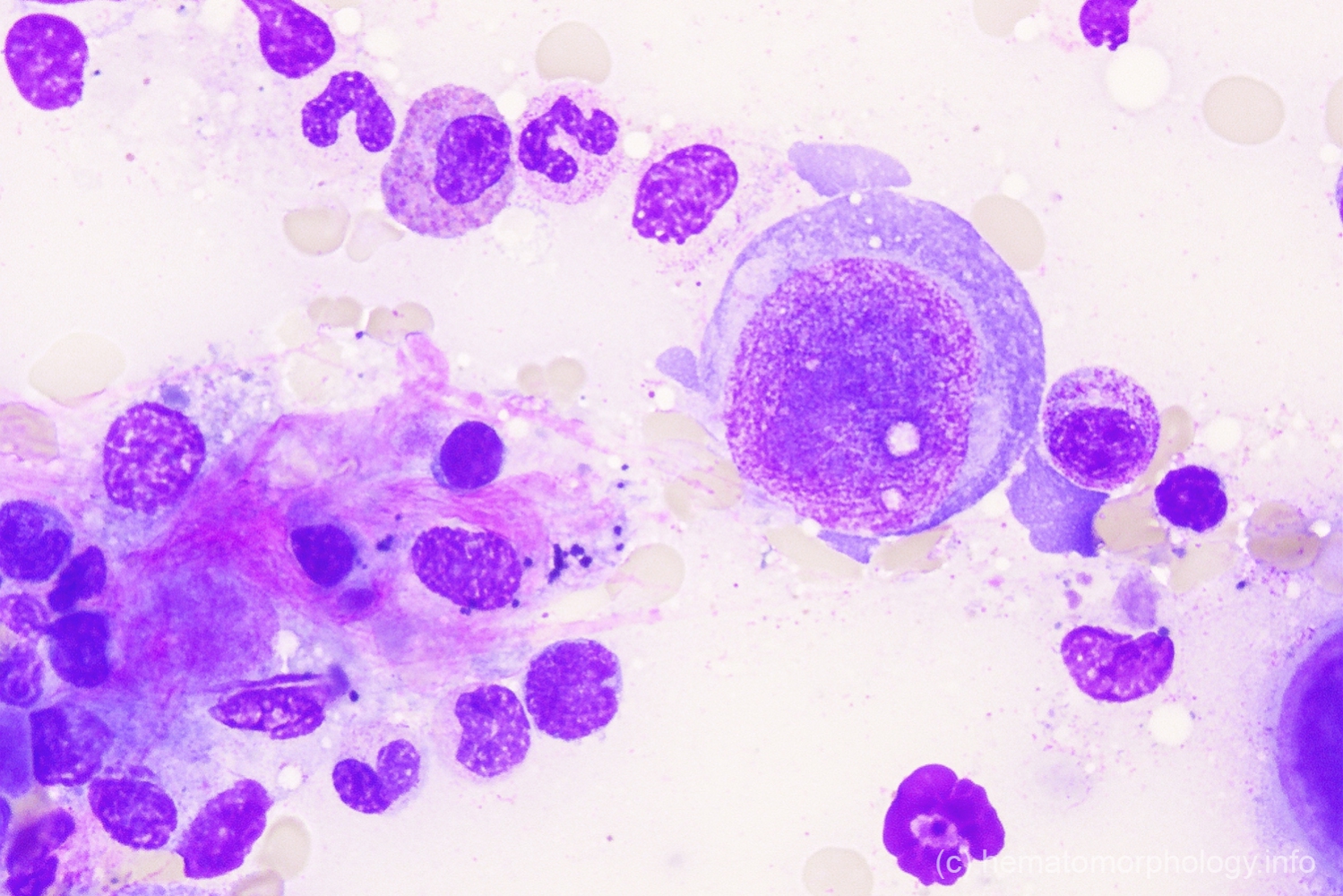 Parvo infection - Hematomorphology, a databank / imagebank for ...