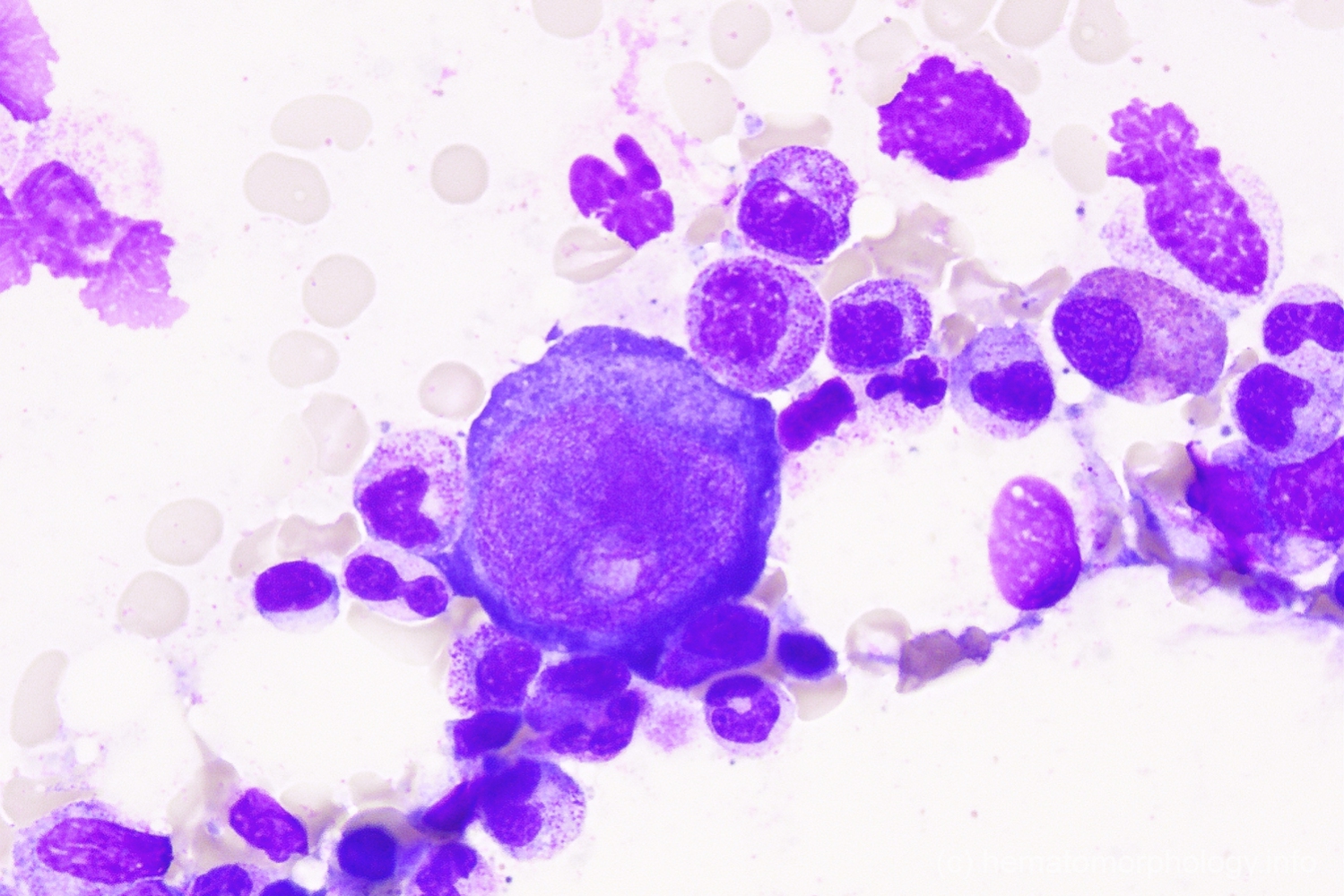 Parvo infection - Hematomorphology, a databank / imagebank for ...