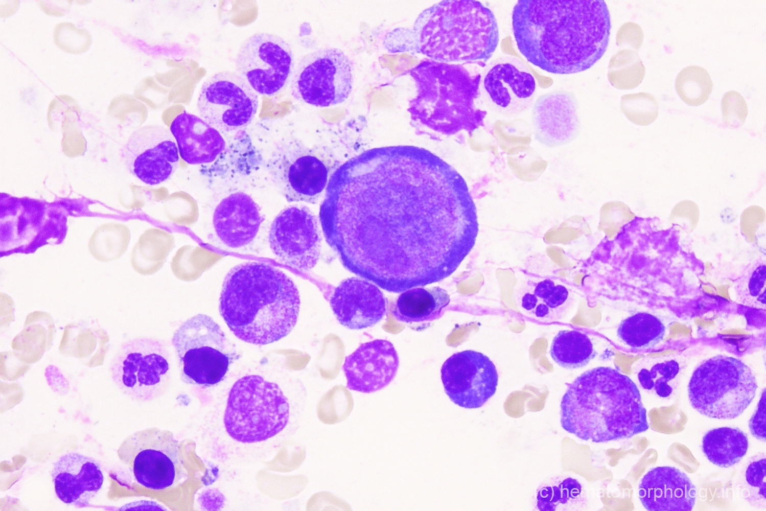 Parvo infection - Hematomorphology, a databank / imagebank for ...