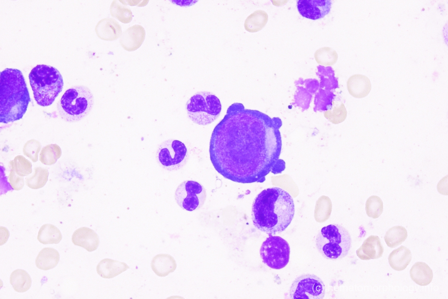 Parvo infection - Hematomorphology, a databank / imagebank for ...