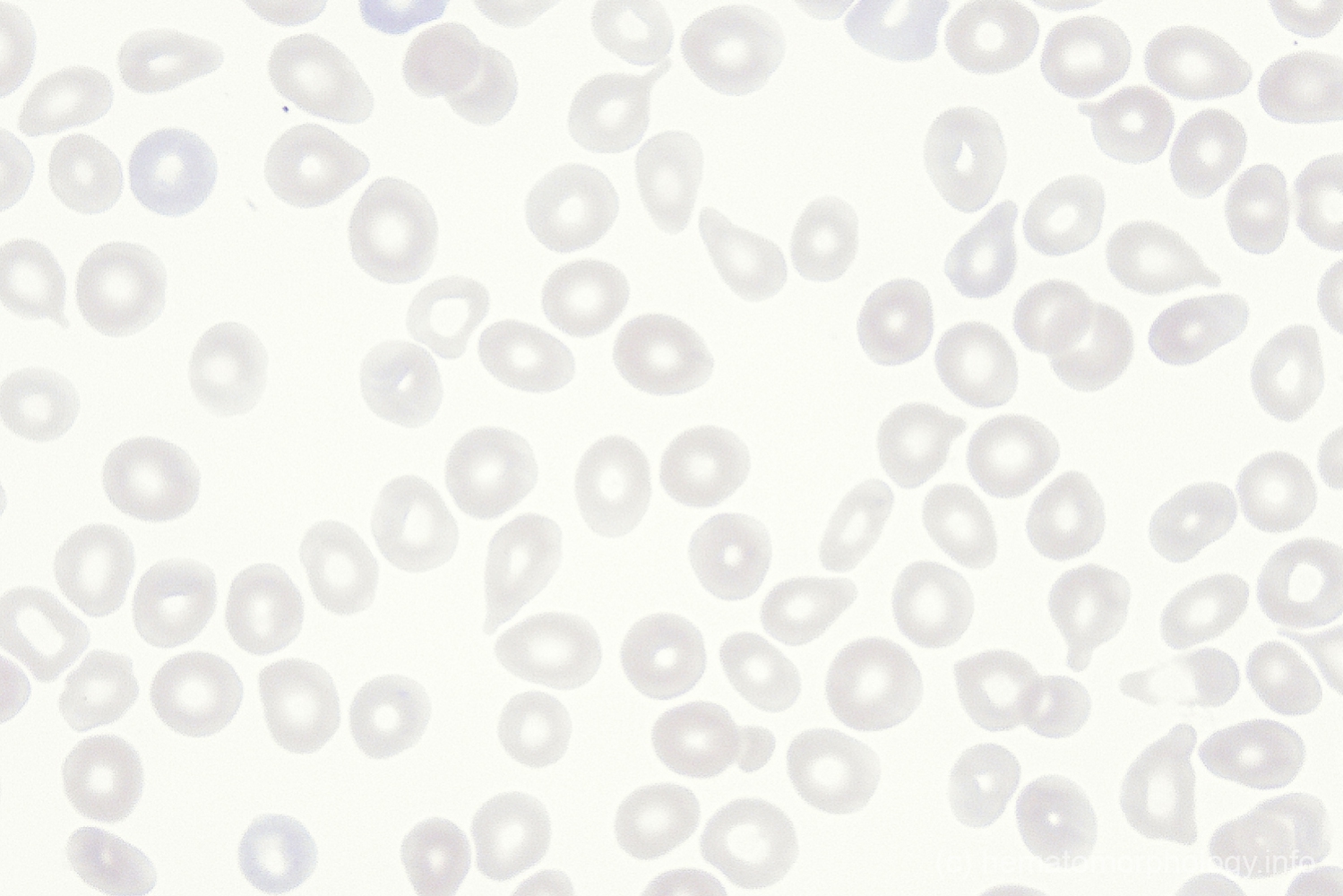 Teardrop cells Hematomorphology, a databank / imagebank for