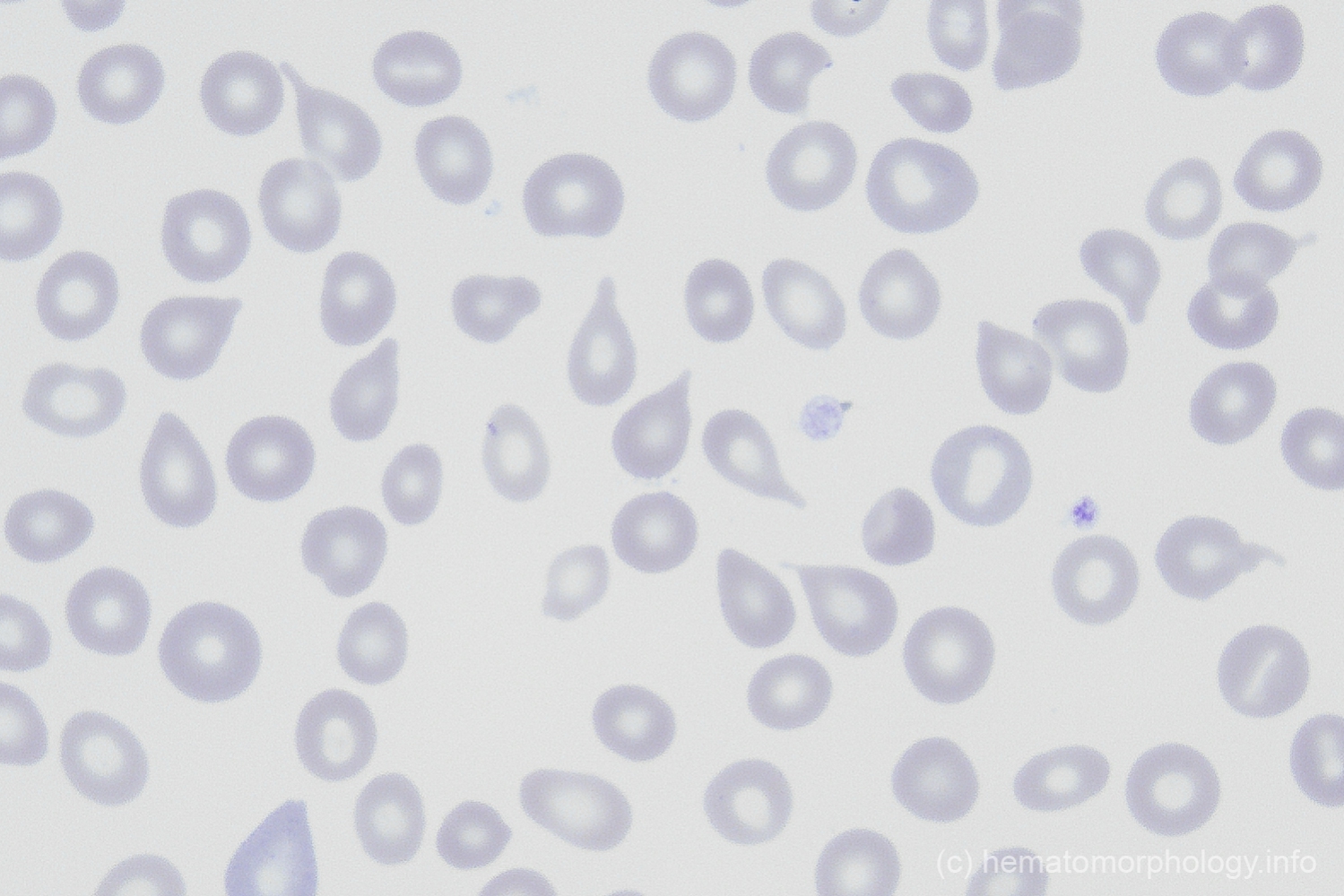 Teardrop cells Hematomorphology, a databank / imagebank for