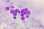 AML-M3-BM-20-denoise-denoise