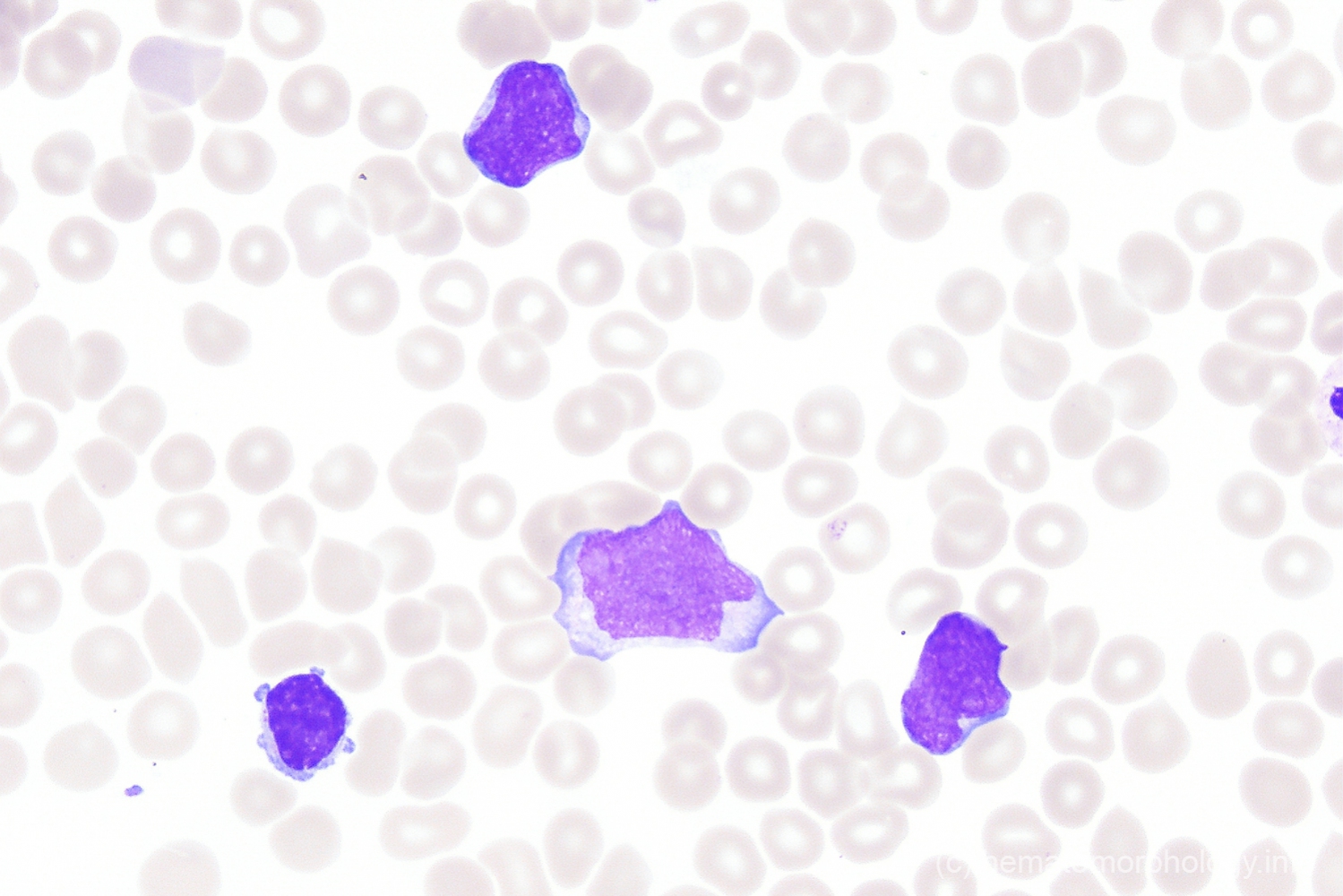 Hematology Blasts Pictures: Hemato Morphology Pdf – KCER