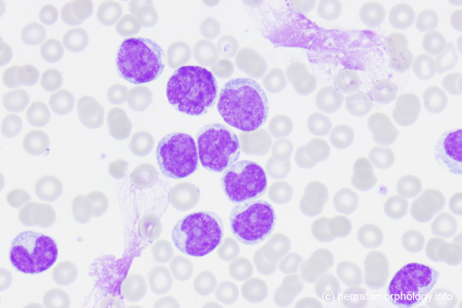 Blastic plasmacytoid dendritic cell neoplasm (bpdcn) - hematomorphology