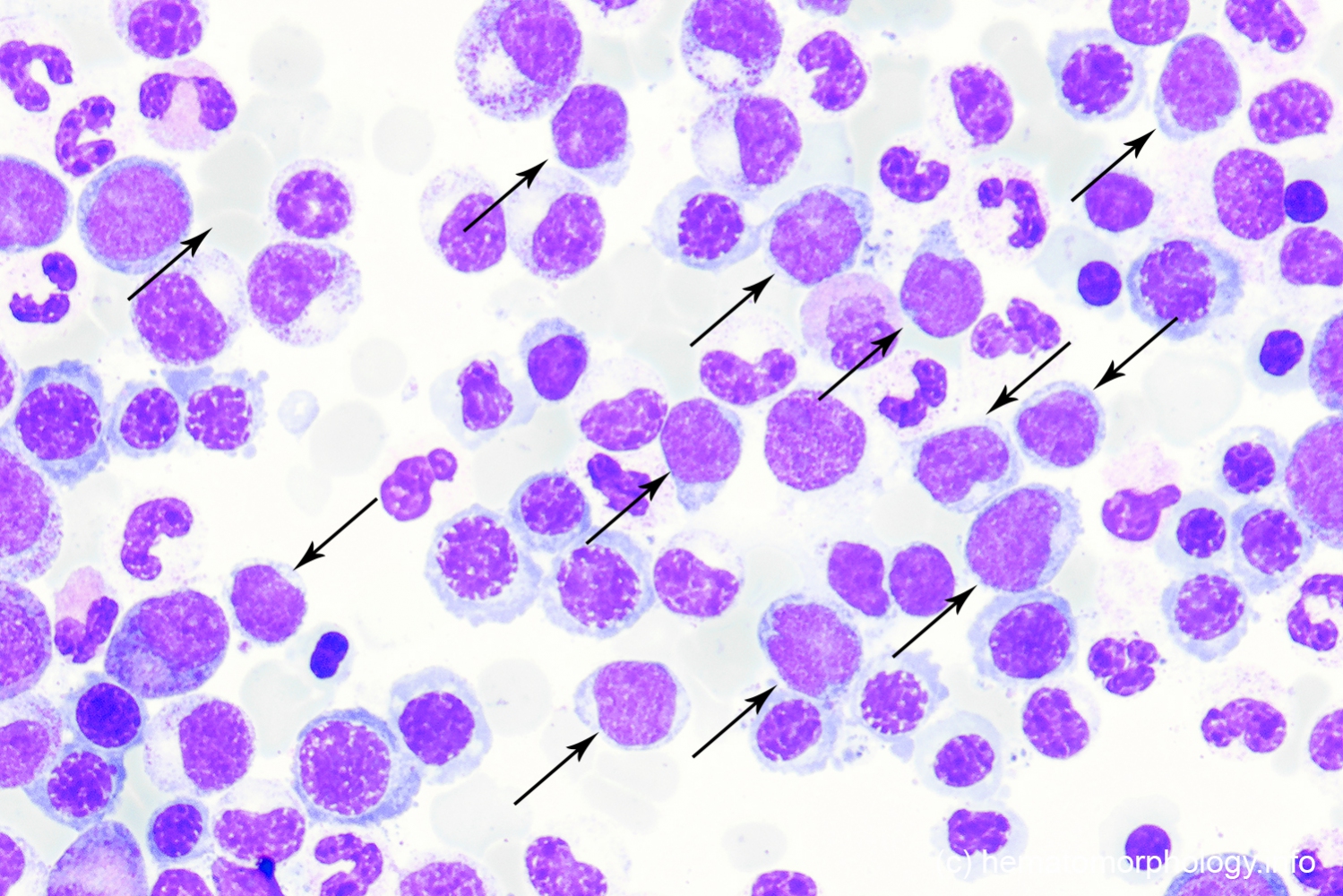 MDS With Excess Of Blasts EB 2 Hematomorphology A Databank 