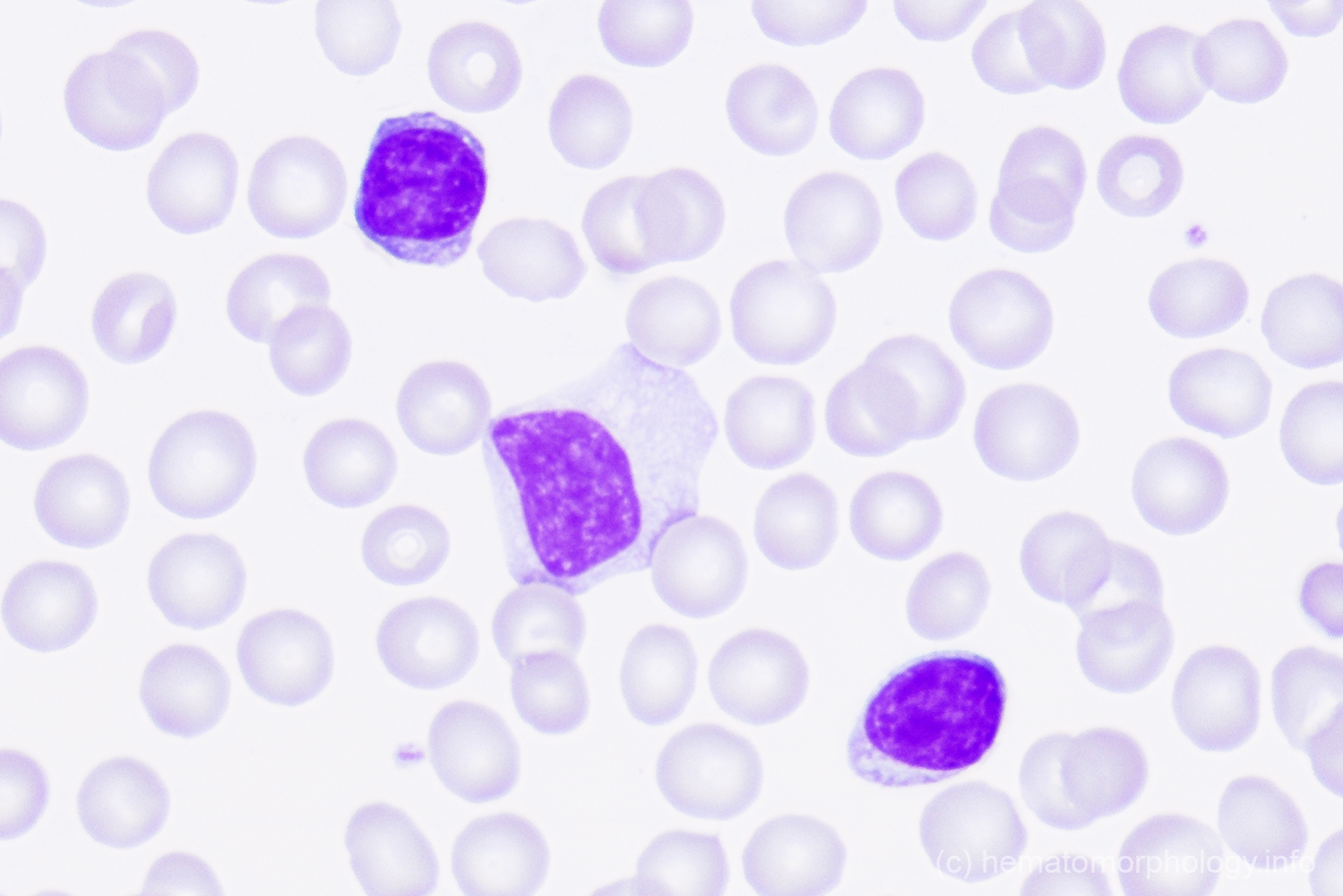 Mononucleosis cuando puedo volver a besar