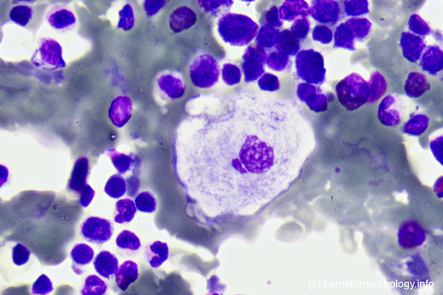 Gaucher's disease Hematomorphology, a databank / imagebank for