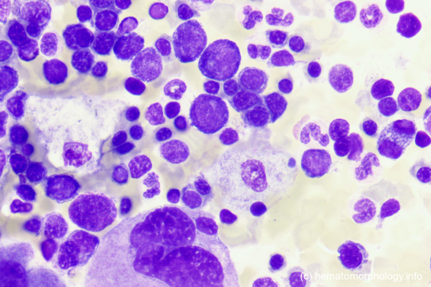 Gaucher's disease Hematomorphology, a databank / imagebank for