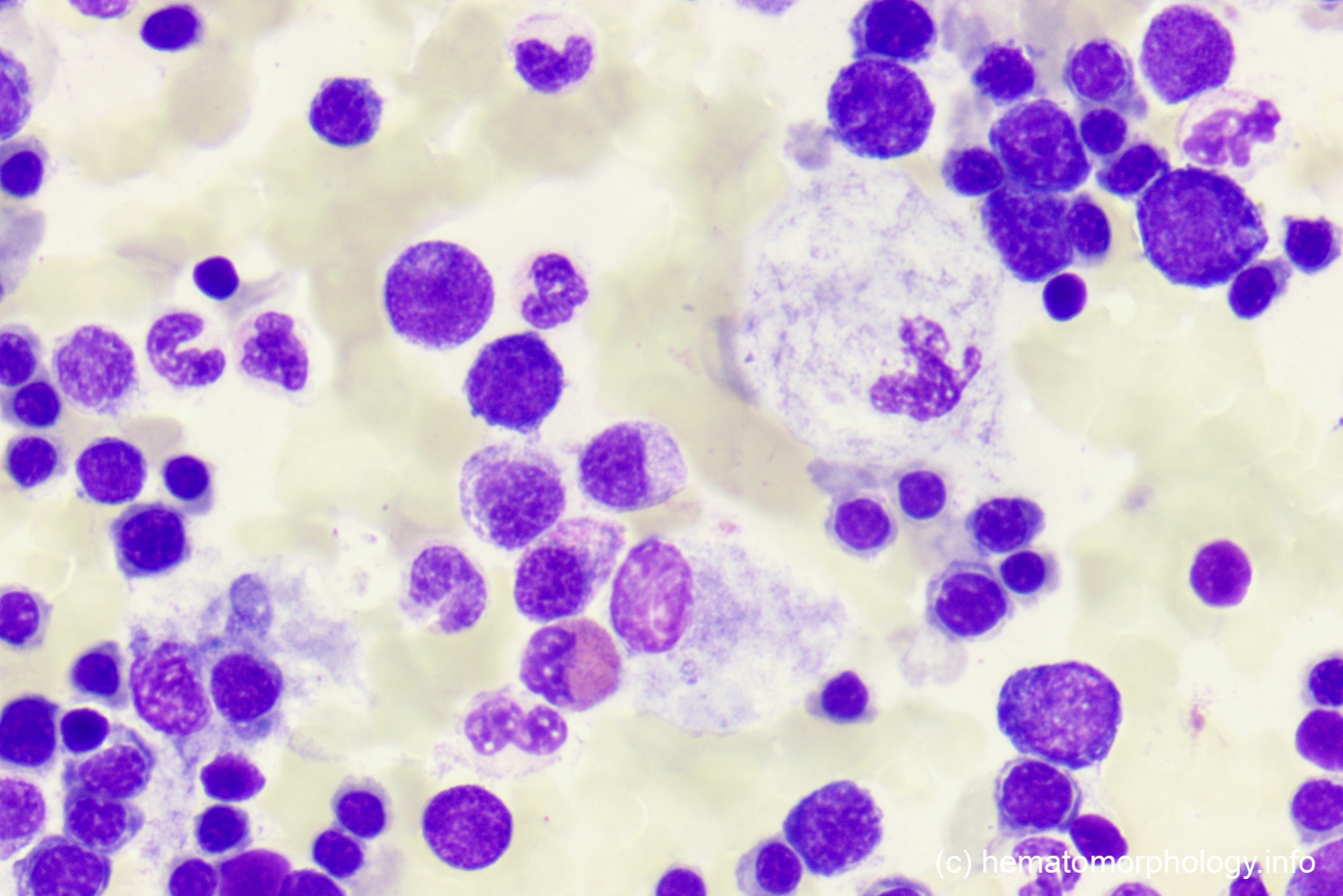 Gaucher's disease Hematomorphology, a databank / imagebank for