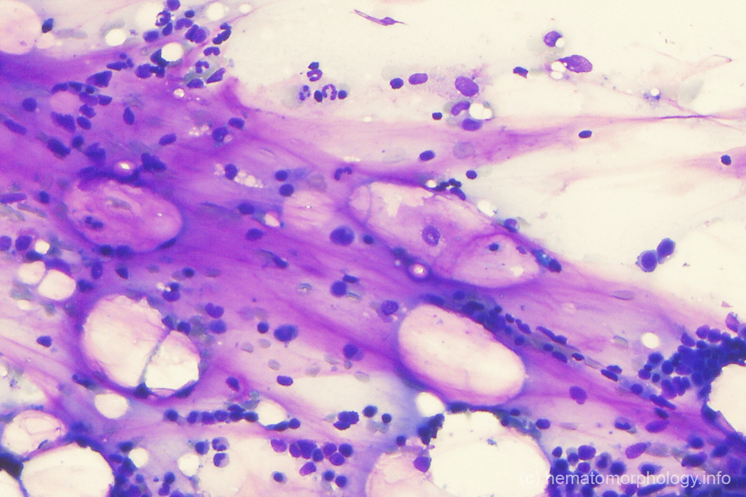 Gelatinous transformation Hematomorphology, a databank / imagebank