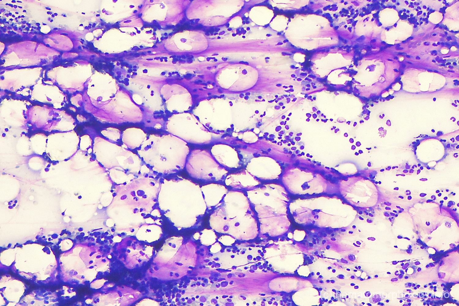 Gelatinous transformation Hematomorphology, a databank / imagebank