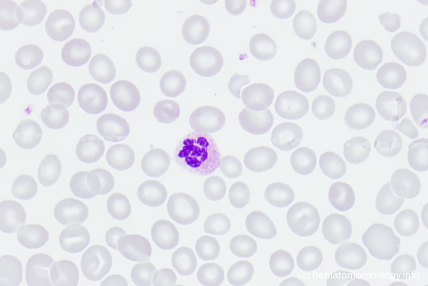 Macrocytosis Hematomorphology, a databank / imagebank for hematology, blood and bone marrow