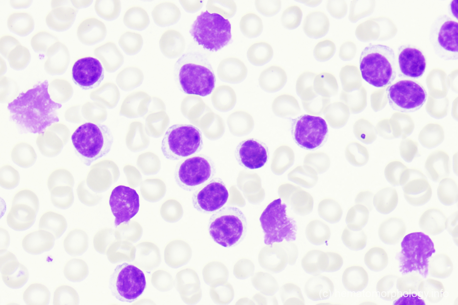 Malignant changes Hematomorphology, a databank / imagebank for