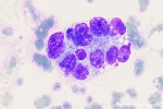 mammacarcinoom-bm-31
