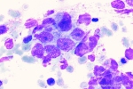mammacarcinoom-bm-35