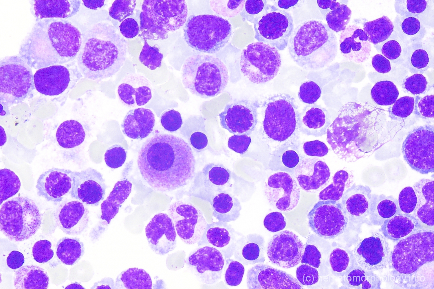 MDS multi lineage dysplasia (MLD) - Hematomorphology, a databank