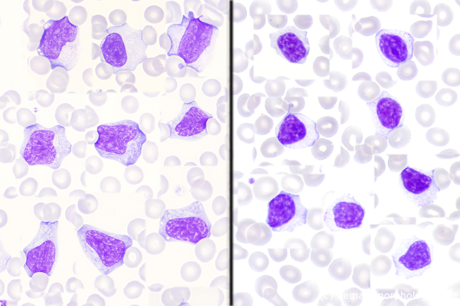 NK-cell Large Granular Lymphocyic leukemia (NK-LGL) / chronic NK cell ...