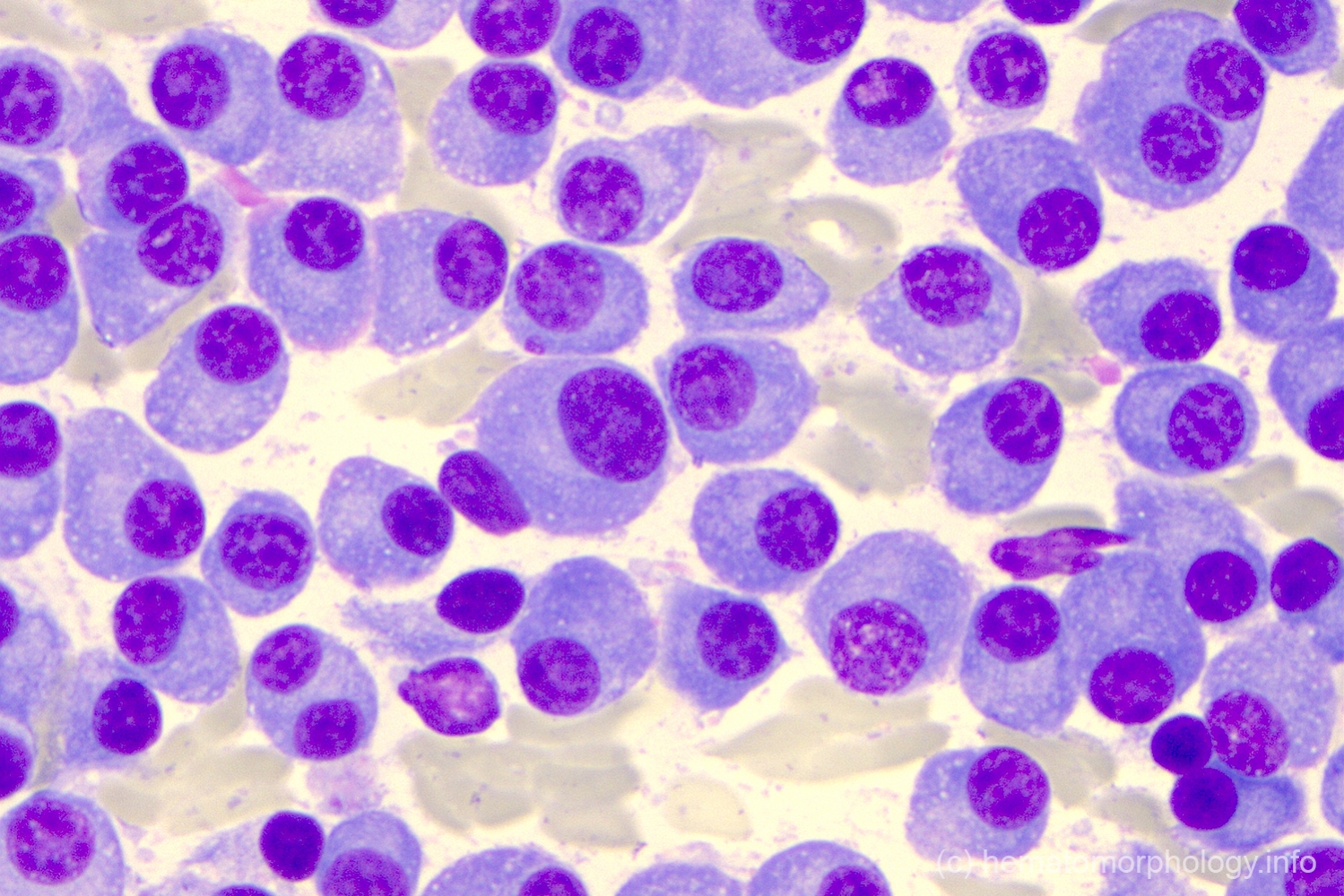 Plasma Cell Myeloma Hematomorphology A Databank Imagebank For