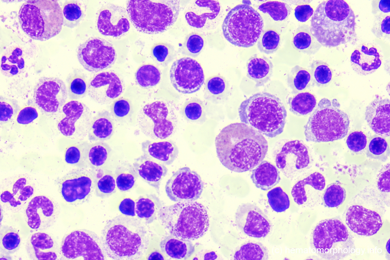 Polycythemia Vera Pv Hematomorphology A Databank Imagebank For Free