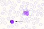 EBV-pb-10-denoise-denoise