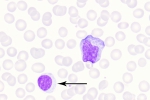 EBV-pb-14-denoise-denoise