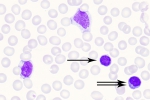 EBV-pb-18-denoise-denoise