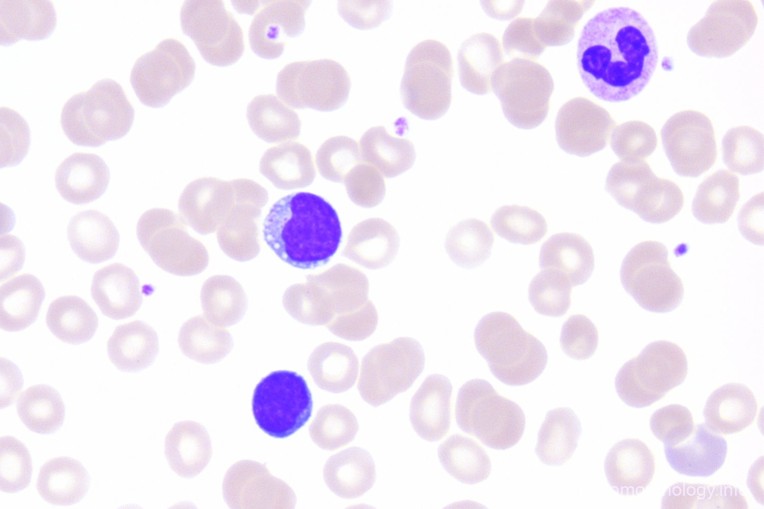 T-cell Large Granular Lymphocyic leukemia (T-LGL) - Hematomorphology, a ...