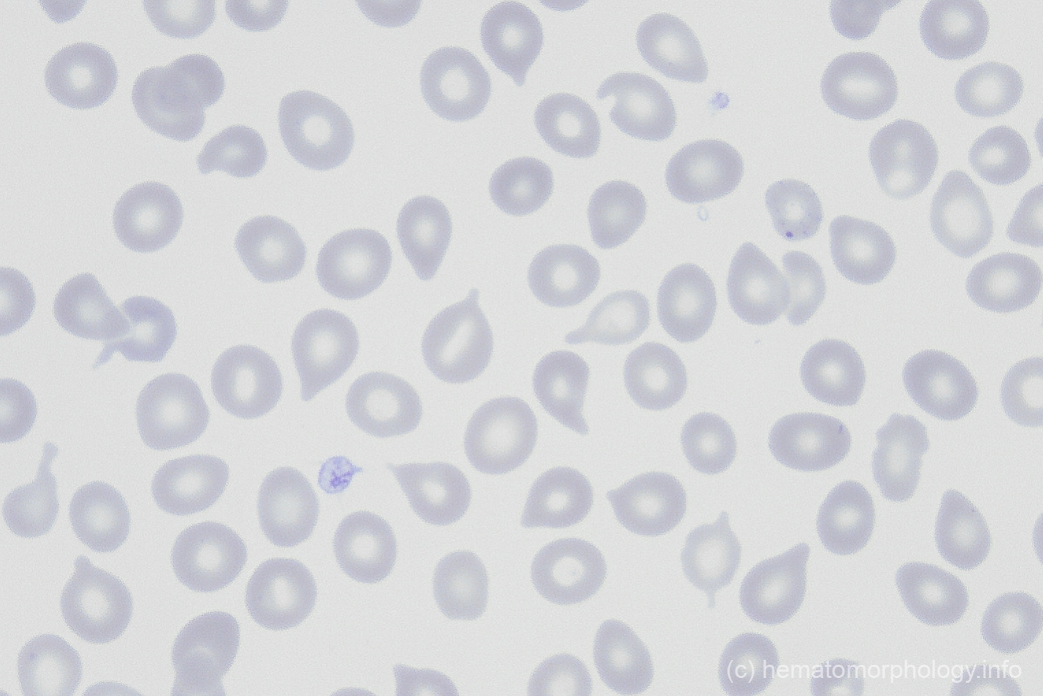 Teardrop cells Hematomorphology, a databank / imagebank for