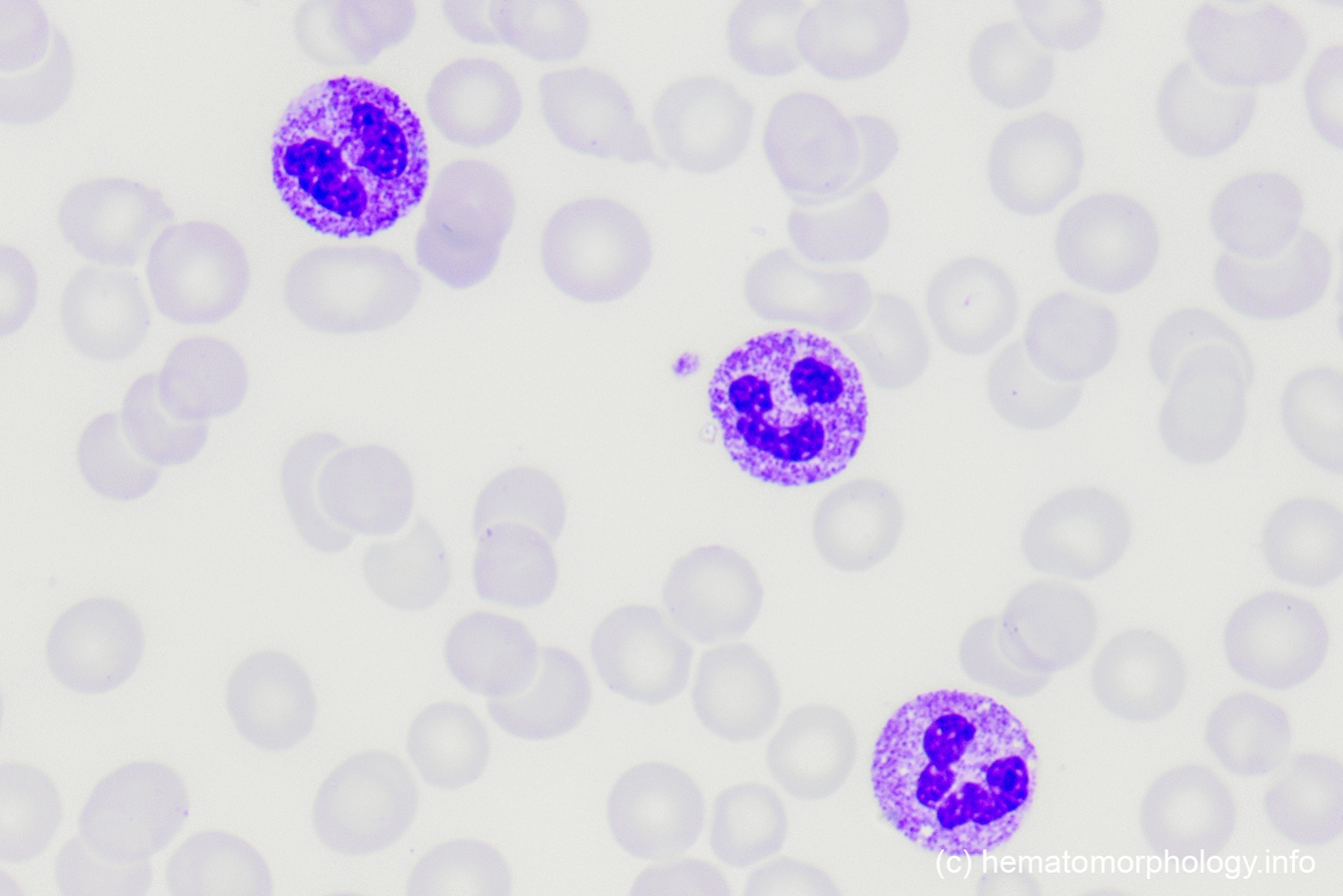 Toxic granulation & Döhle inclusion bodies Hematomorphology, a
