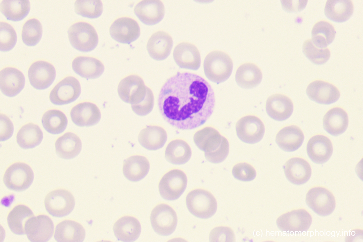 Toxic granulation & Döhle inclusion bodies Hematomorphology, a